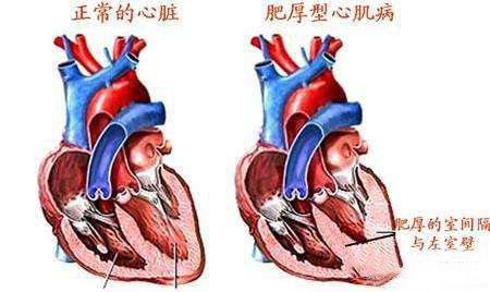 肥厚心肌病最新治療方法與研究進(jìn)展