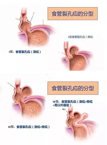 腺肌癥最新治療方法詳解與論述
