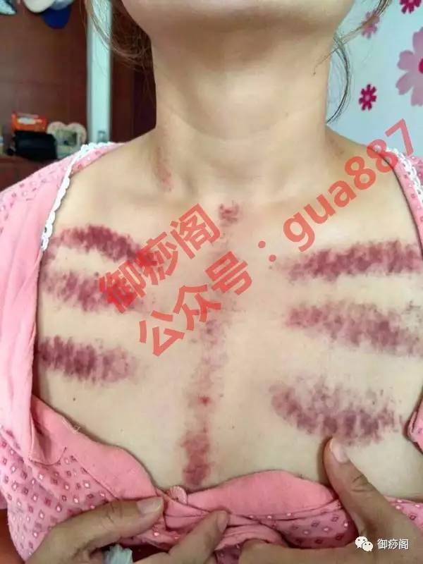 揪頸胸痧揭秘，自然美景探索之旅開(kāi)啟